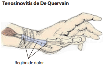 TENOSINOVITIS de Quervain