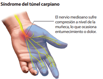 Síndrome del TUNEL CARPIANO: